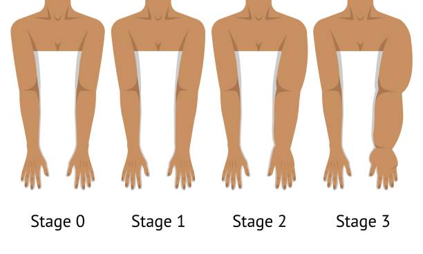 Lymphedema Management: Physiotherapy Techniques That Actually Work “Lymphedema physiotherapy treatment with manual lymphatic drainage and compression bandaging”